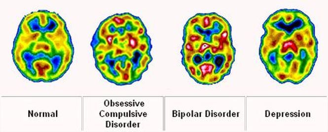 how-to-tell-the-difference-between-bipolar-disorder-and-depression-neuroinnovations